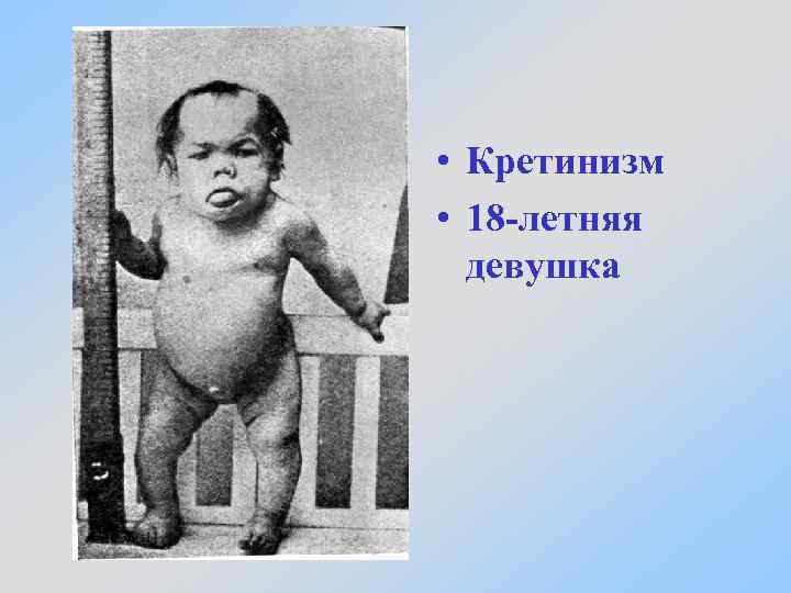  • Кретинизм • 18 -летняя девушка 