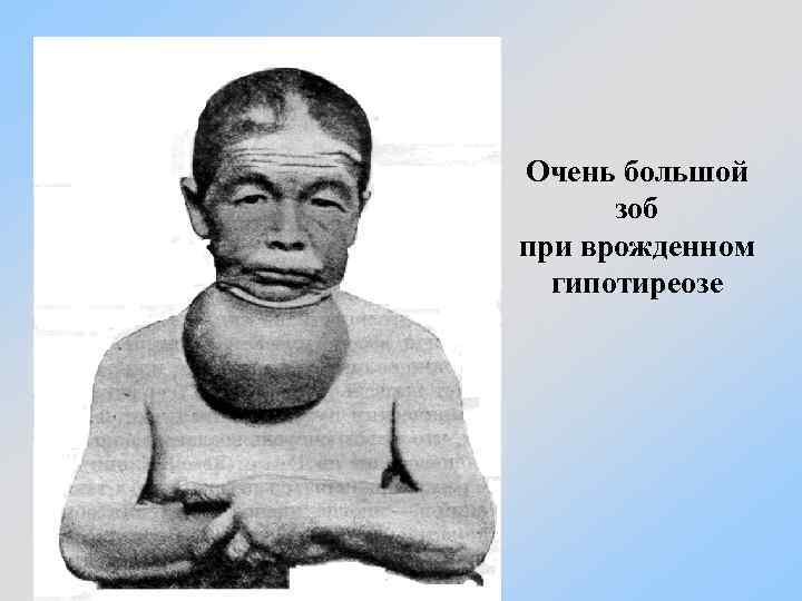 Очень большой зоб при врожденном гипотиреозе 