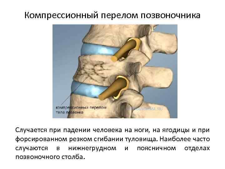 Компрессионный перелом позвоночника матрас