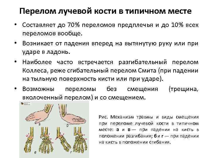 Перелом лучевой кости в типичном месте • Составляет до 70% переломов предплечья и до