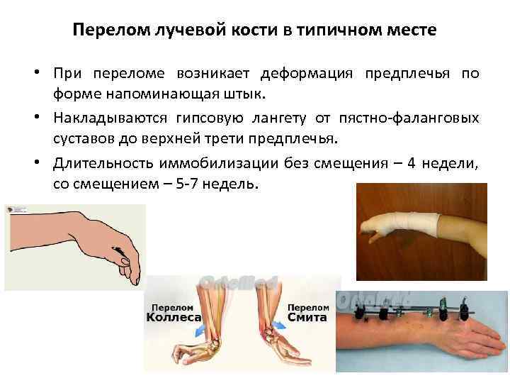 Перелом лучевой кости в типичном месте карта вызова закрытый