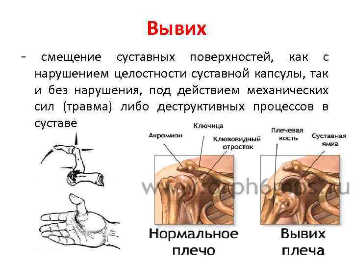 Вывих - смещение суставных поверхностей, как с нарушением целостности суставной капсулы, так и без