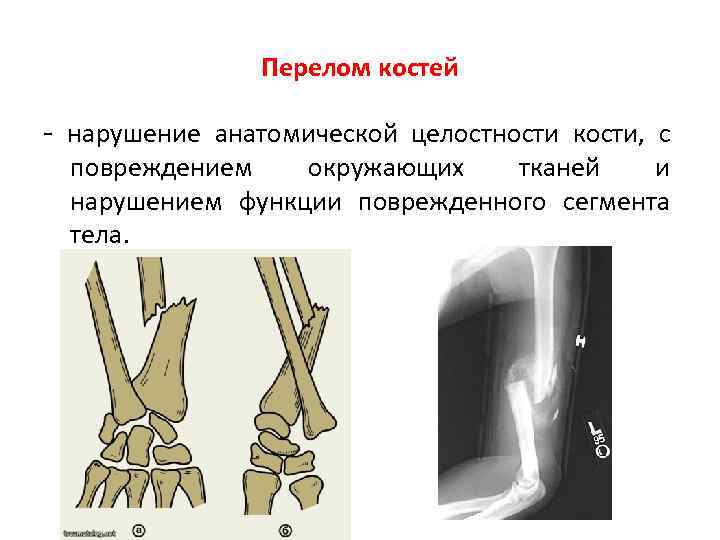 Перелом костей - нарушение анатомической целостности кости, с повреждением окружающих тканей и нарушением функции