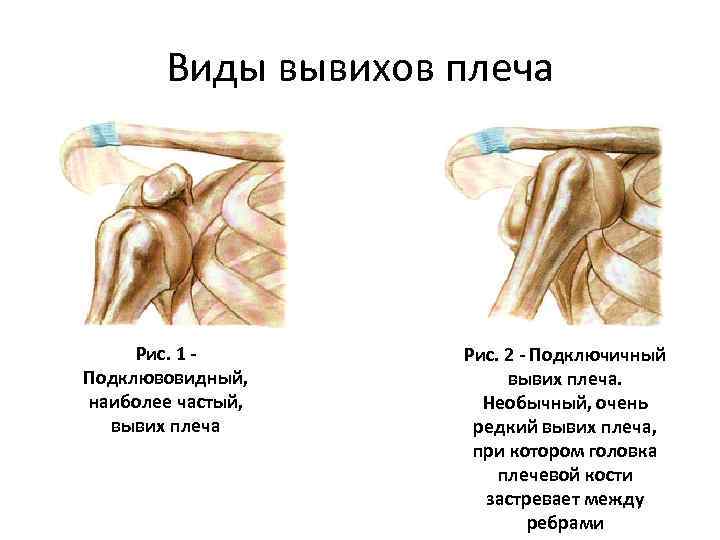 Виды вывихов плеча Рис. 1 - Подклювовидный, наиболее частый, вывих плеча Рис. 2 -
