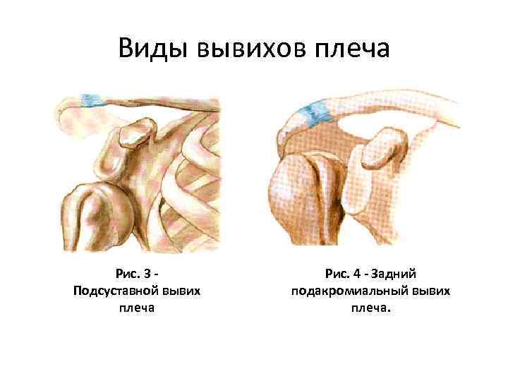 Виды вывихов плеча Рис. 3 - Подсуставной вывих плеча Рис. 4 - Задний подакромиальный