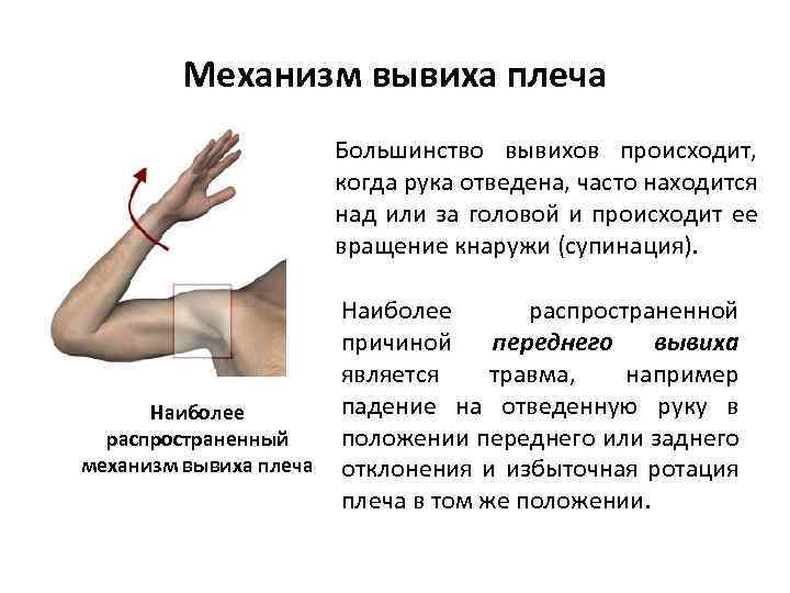 Механизм вывиха плеча Большинство вывихов происходит, когда рука отведена, часто находится над или за