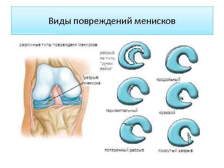 Виды повреждений менисков 