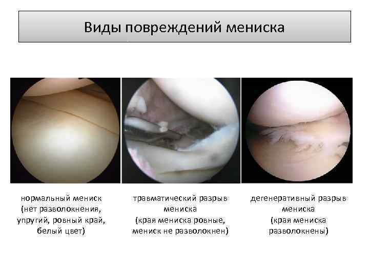 Виды повреждений мениска нормальный мениск (нет разволокнения, упругий, ровный край, белый цвет) травматический разрыв