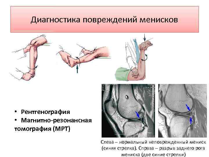 Диагностика повреждений менисков • Рентгенография • Магнитно-резонансная томография (МРТ) Слева – нормальный неповрежденный мениск