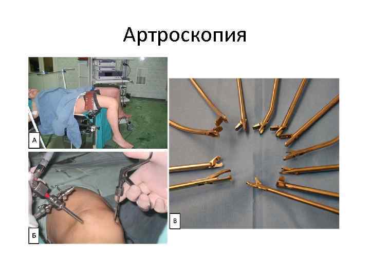Артроскопия 