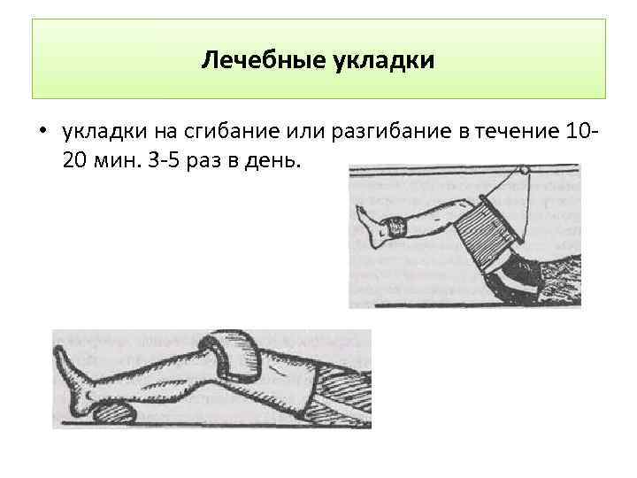 Лечебные укладки • укладки на сгибание или разгибание в течение 1020 мин. 3 -5