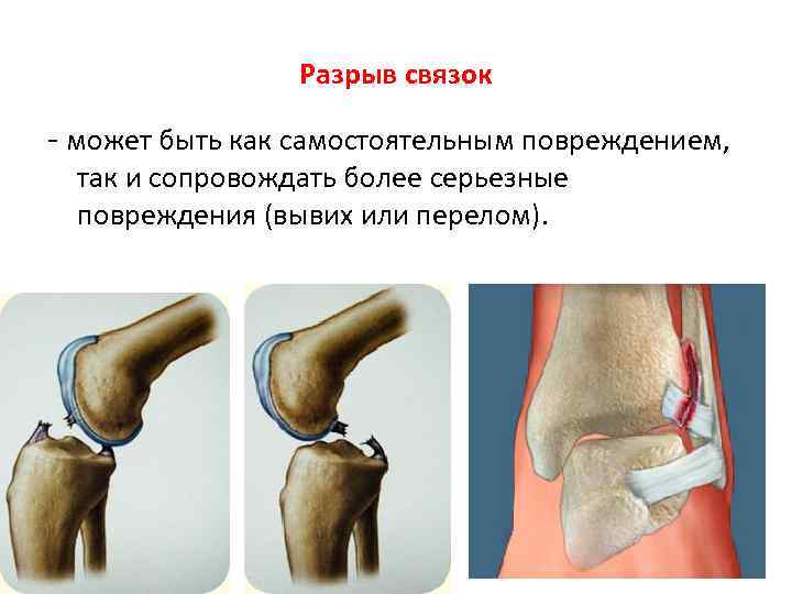 Разрыв связок - может быть как самостоятельным повреждением, так и сопровождать более серьезные повреждения