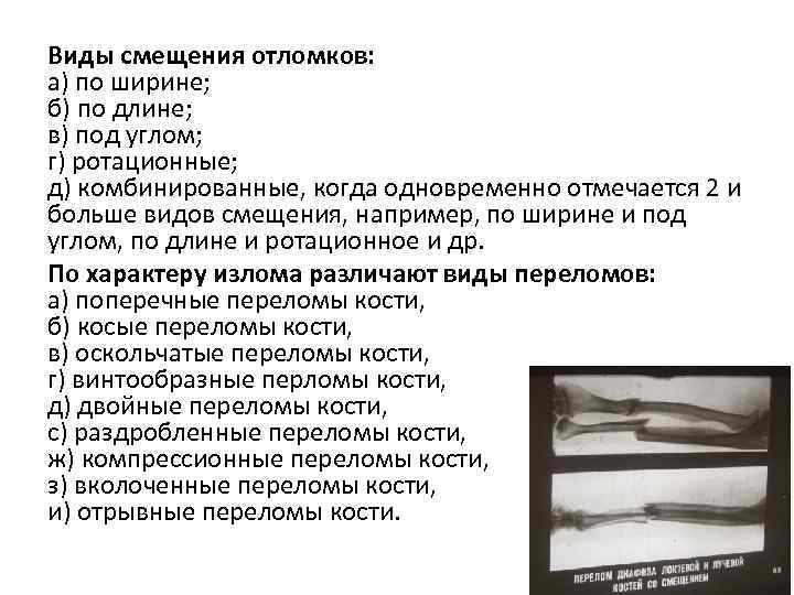 Виды смещения отломков: а) по ширине; б) по длине; в) под углом; г) ротационные;