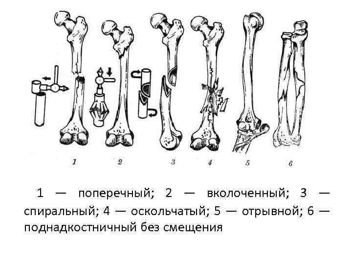  1 — поперечный; 2 — вколоченный; 3 — спиральный; 4 — оскольчатый; 5