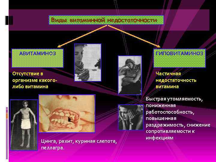 Виды витаминной недостаточности АВИТАМИНОЗ Отсутствие в организме какоголибо витамина Цинга, рахит, куриная слепота, пеллагра.