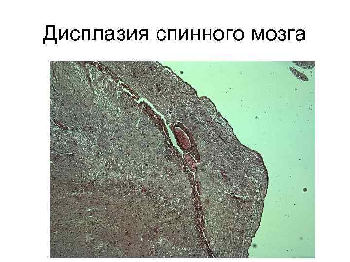 Дисплазия спинного мозга 