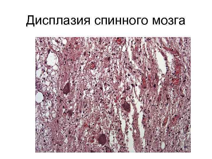 Дисплазия спинного мозга 