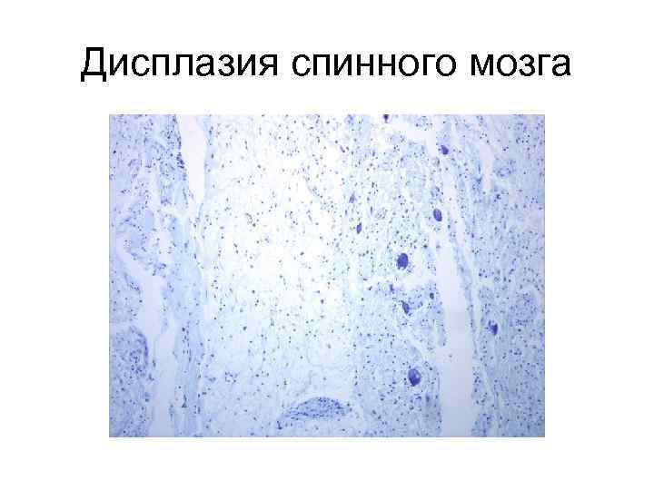 Дисплазия спинного мозга 