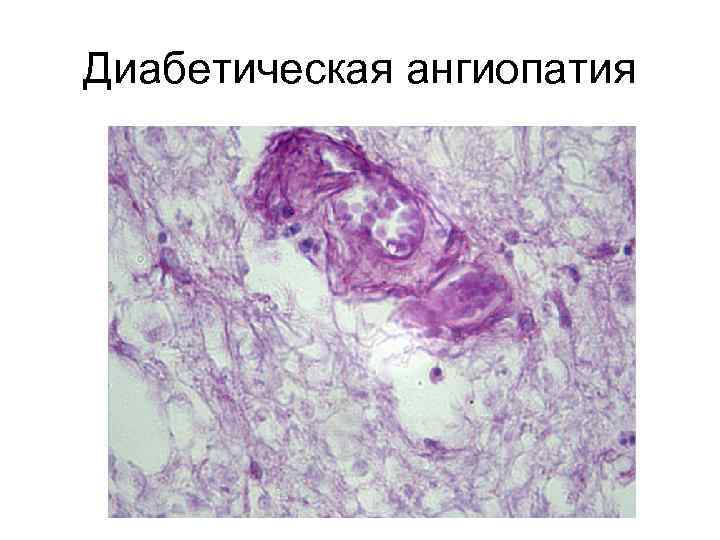 Диабетическая ангиопатия 