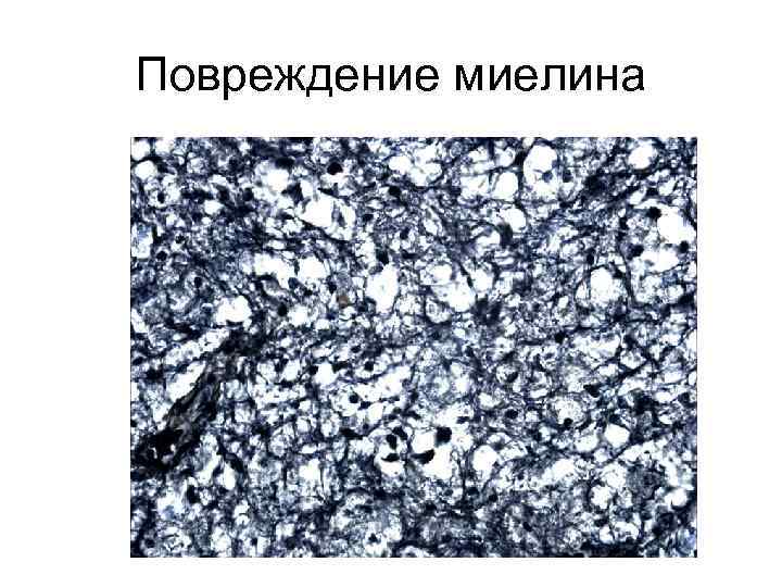 Повреждение миелина 