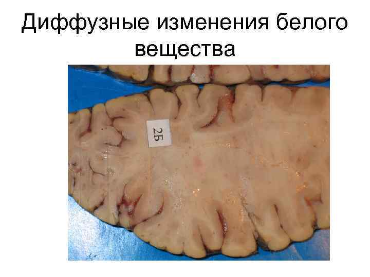 Диффузные изменения белого вещества 