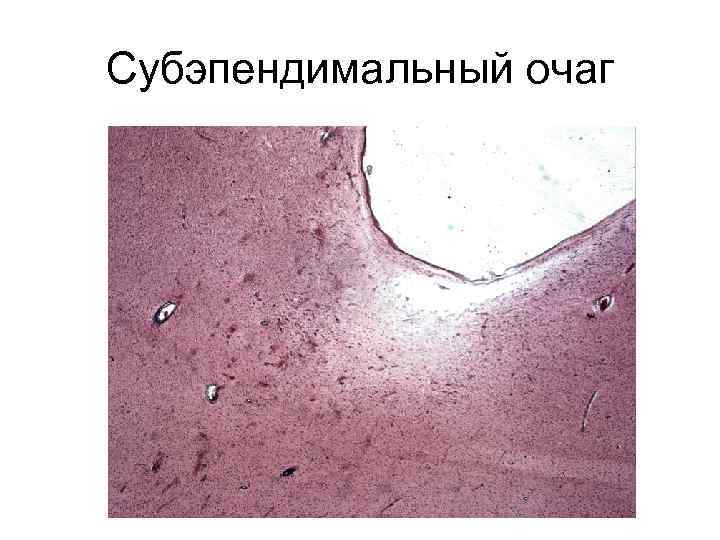 Субэпендимальный очаг 
