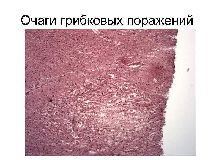 Очаги грибковых поражений 