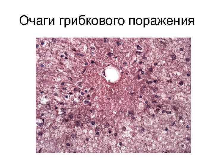 Очаги грибкового поражения 