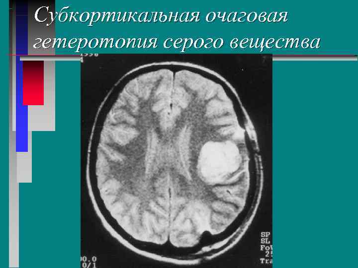 Гетеротопия. Субэпендимарная гетеротопия серого вещества. Очаговая гетеротопия серого вещества. Гетеротопия серого вещества головного мозга. Субкортикальная гетеротопия.