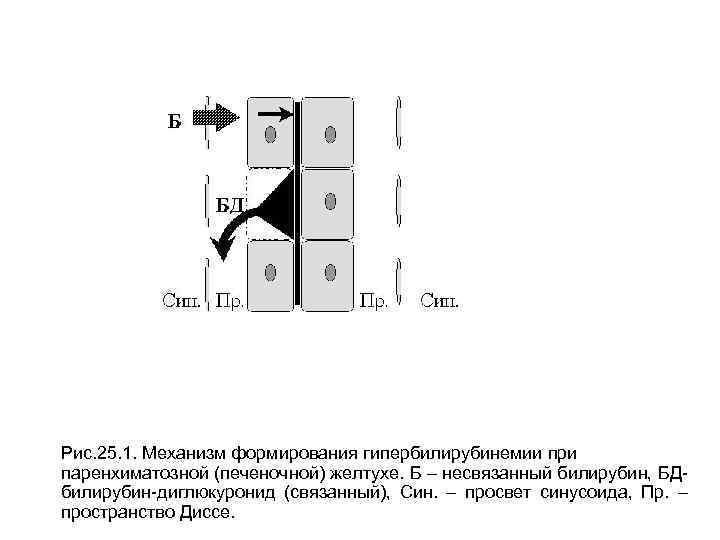 Рис. 25. 1. Механизм формирования гипербилирубинемии при паренхиматозной (печеночной) желтухе. Б – несвязанный билирубин,