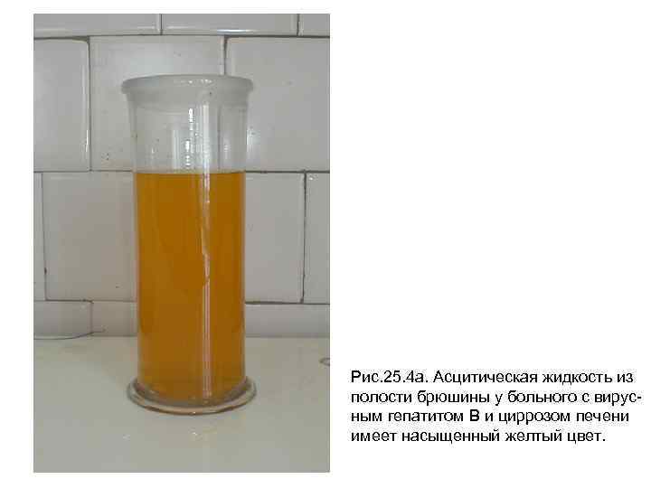 Рис. 25. 4 а. Асцитическая жидкость из полости брюшины у больного с вирусным гепатитом