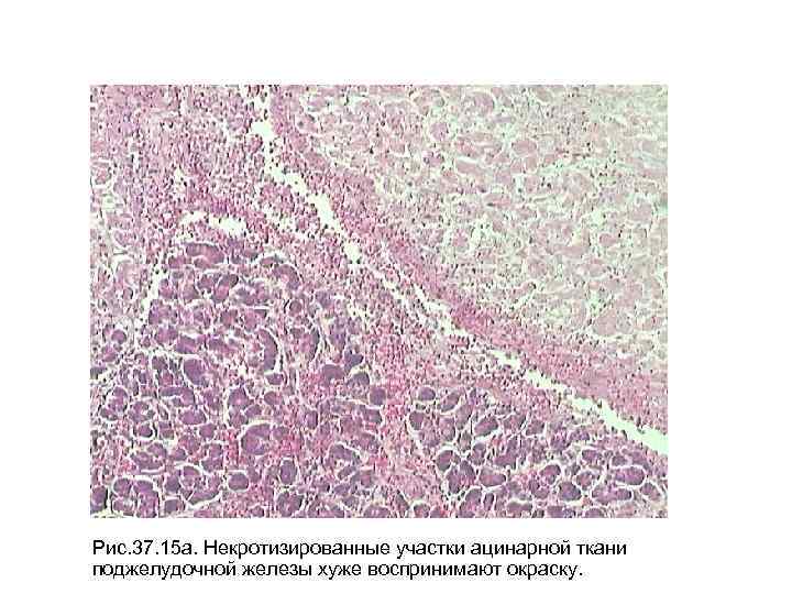 Рис. 37. 15 а. Некротизированные участки ацинарной ткани поджелудочной железы хуже воспринимают окраску. 