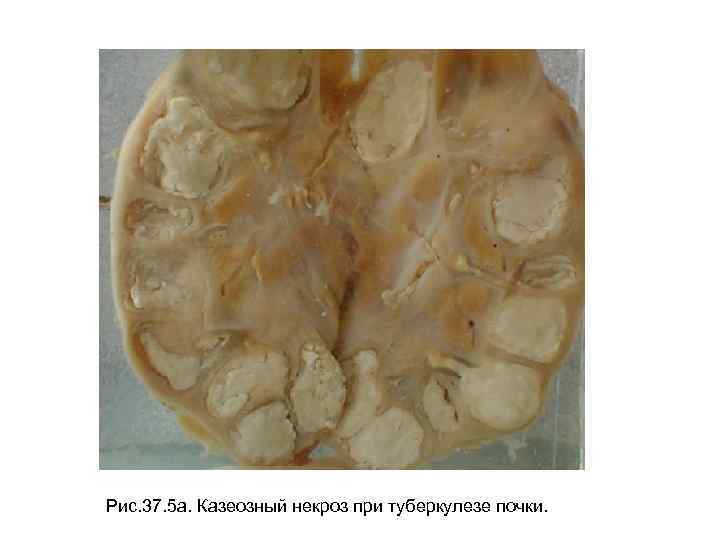 Рис. 37. 5 а. Казеозный некроз при туберкулезе почки. 