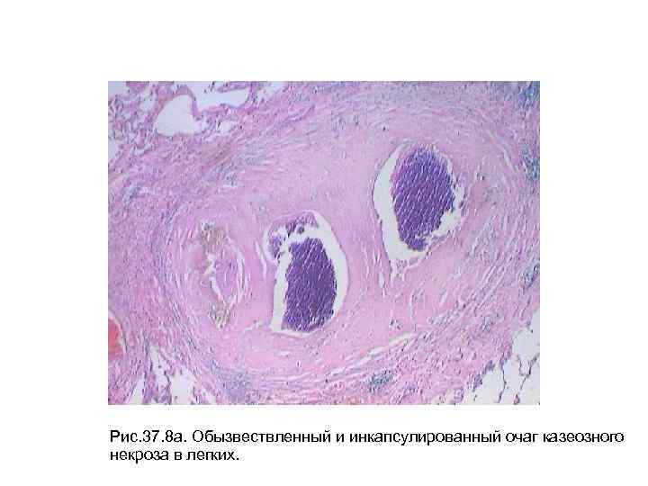 Рис. 37. 8 а. Обызвествленный и инкапсулированный очаг казеозного некроза в легких. 
