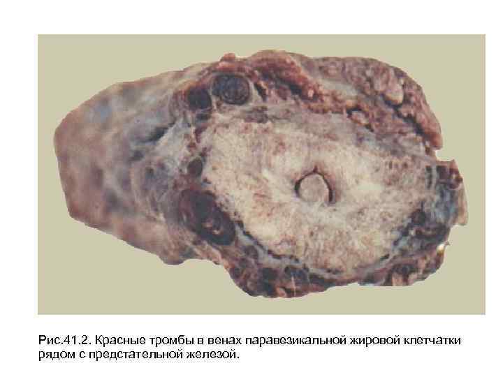 Рис. 41. 2. Красные тромбы в венах паравезикальной жировой клетчатки рядом с предстательной железой.