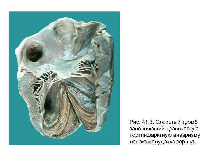 Рис. 41. 3. Слоистый тромб, заполняющий хроническую постинфарктную аневризму левого желудочка сердца. 