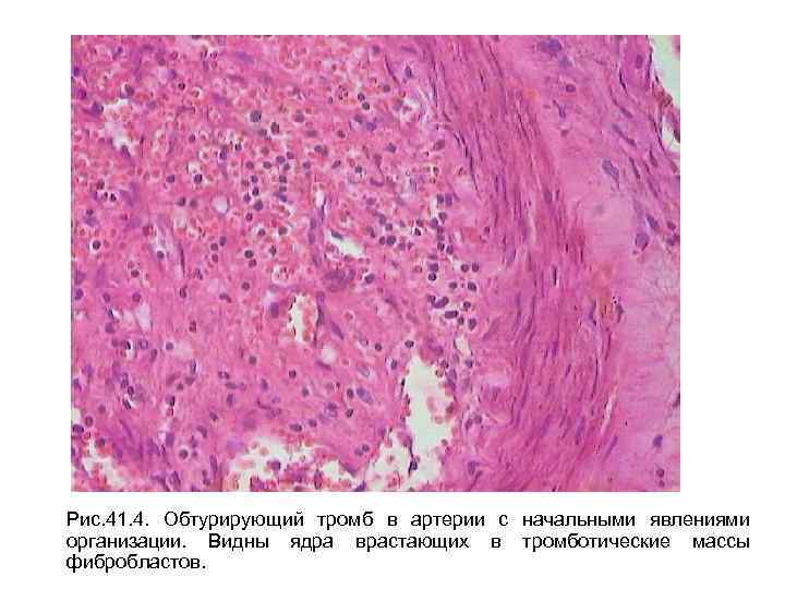 Рис. 41. 4. Обтурирующий тромб в артерии с начальными явлениями организации. Видны ядра врастающих