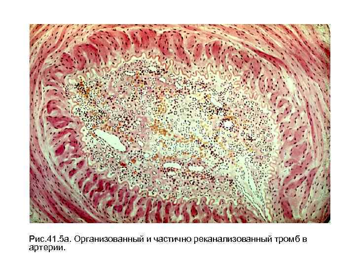 Рис. 41. 5 а. Организованный и частично реканализованный тромб в артерии. 