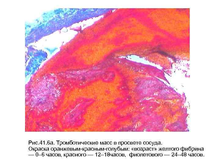 Рис. 41. 6 а. Тромботические масс в просвете сосуда. Окраска оранжевым-красным-голубым: «возраст» желтого фибрина