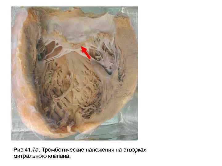 Рис. 41. 7 а. Тромботические наложения на створках митрального клапана. 