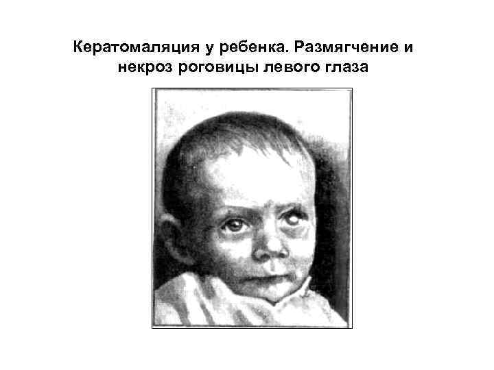 Кератомаляция у ребенка. Размягчение и некроз роговицы левого глаза 