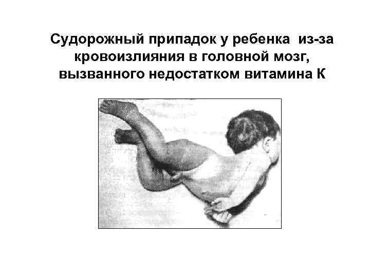 Судорожный припадок у ребенка из-за кровоизлияния в головной мозг, вызванного недостатком витамина К 