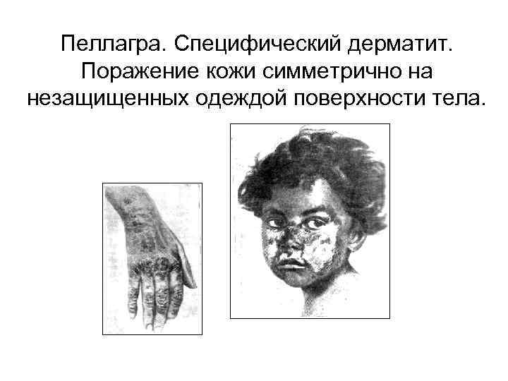 Пеллагра. Специфический дерматит. Поражение кожи симметрично на незащищенных одеждой поверхности тела. 