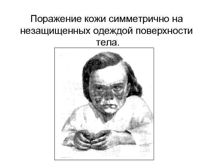 Поражение кожи симметрично на незащищенных одеждой поверхности тела. 