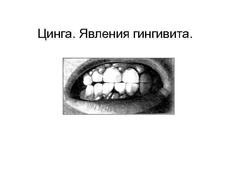 Цинга. Явления гингивита. 