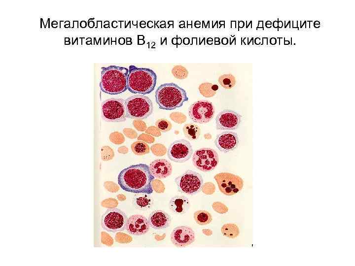 Картина крови при мегалобластной анемии