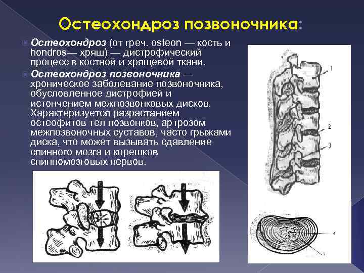 Остеохондроз позвоночника: Остеохондроз (от греч. osteon — кость и hondros— хрящ) — дистрофический процесс