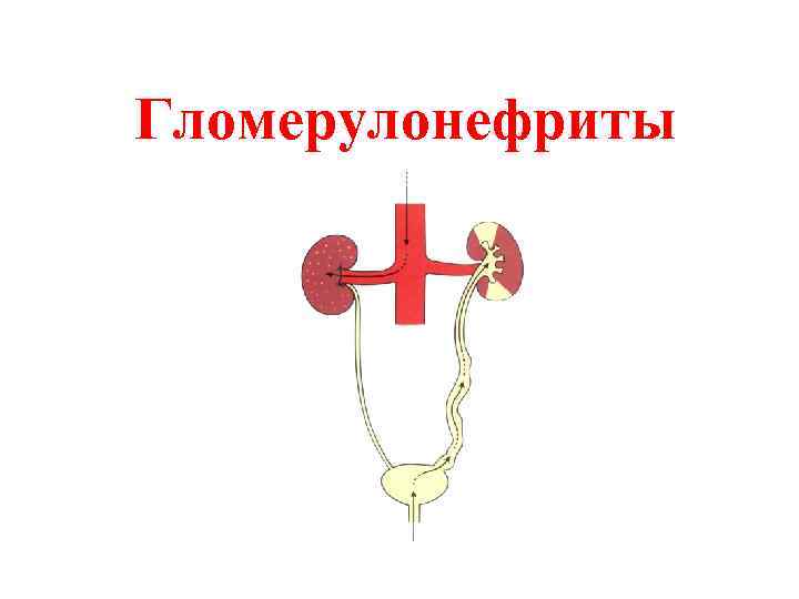 Гломерулонефриты 