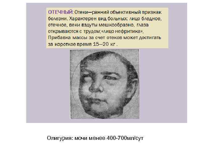 Олигурия: мочи менее 400 -700 мл/сут 