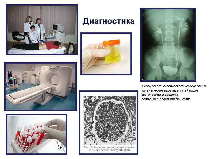 Диагностика Метод рентгенологического исследования почек и мочевыводящих путей после внутривенного введения рентгеноконтрастного вещества. 